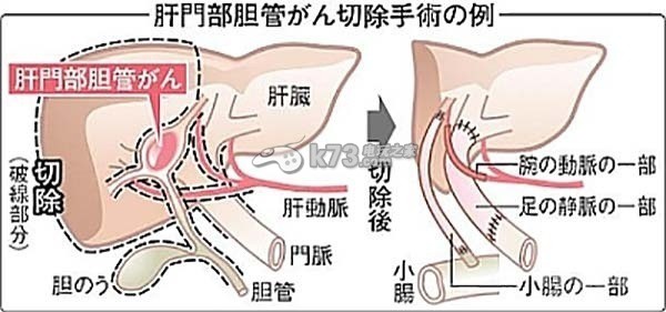 從聰哥離世來聊聊膽管腫瘤